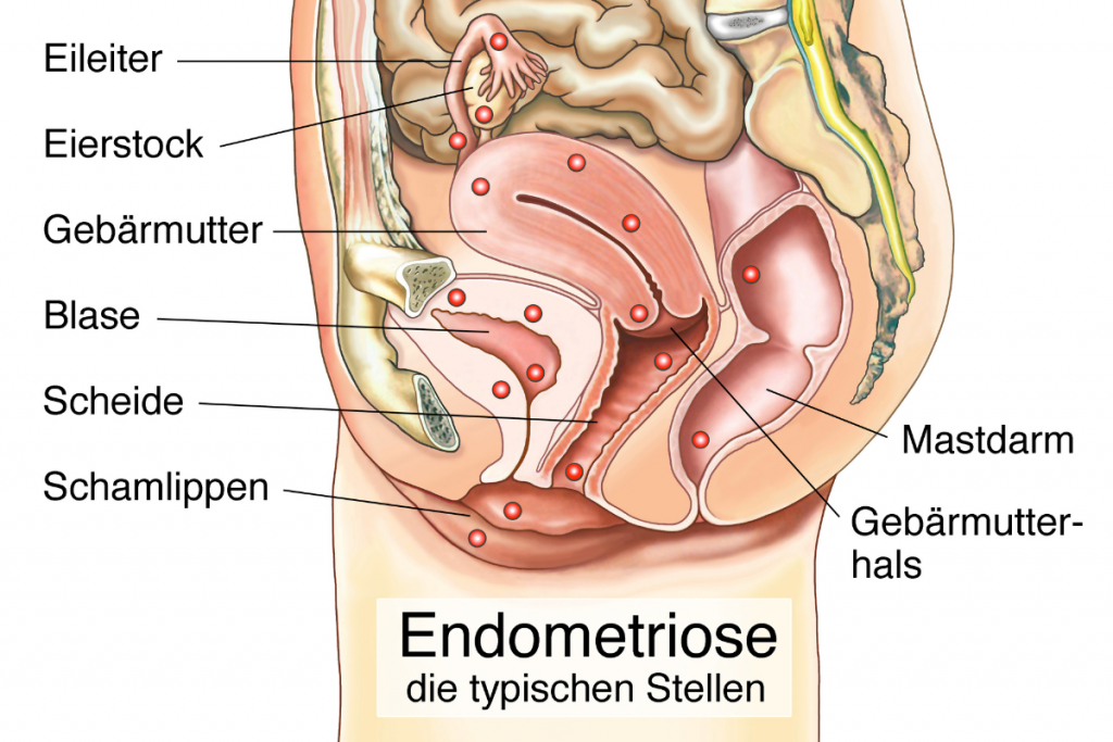 Die typischen Stellen für Endometriose.
